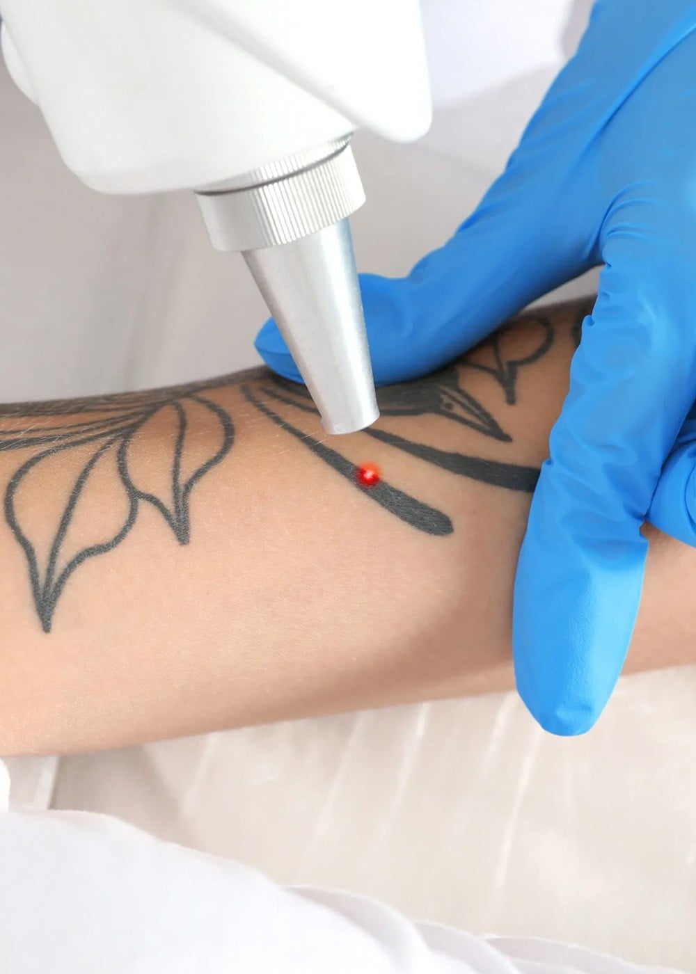 VERWIJDEREN TATTOO'S